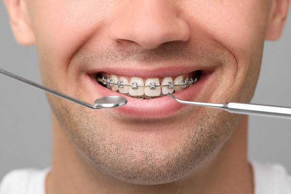 Orthodontic tx - braces treatment at Dental Sense