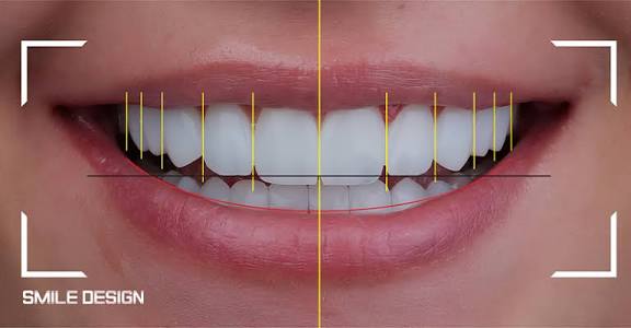 Digital Smile Design at Dental Sense