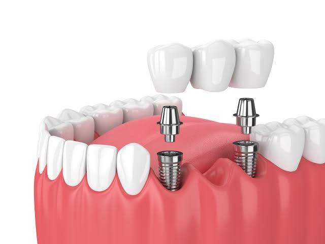 Dental implants at Dental Sense