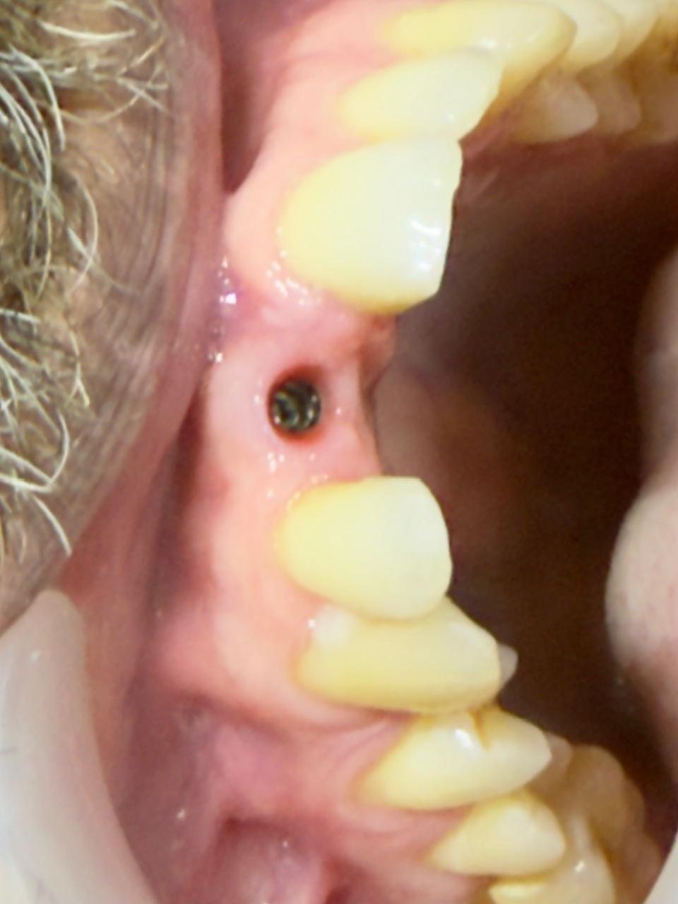 Dental implant treatment view.